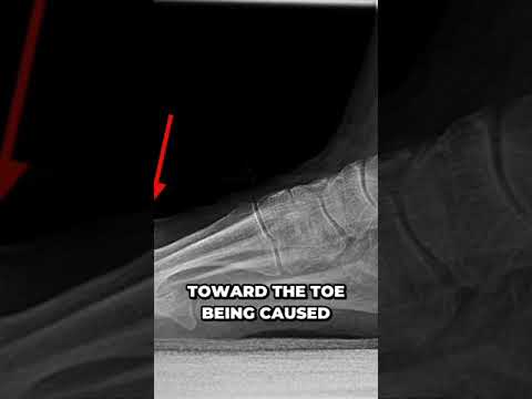 Discovering the surprising source of foot lumps you won't believe @DrNailNipper #mucoidcyst 2