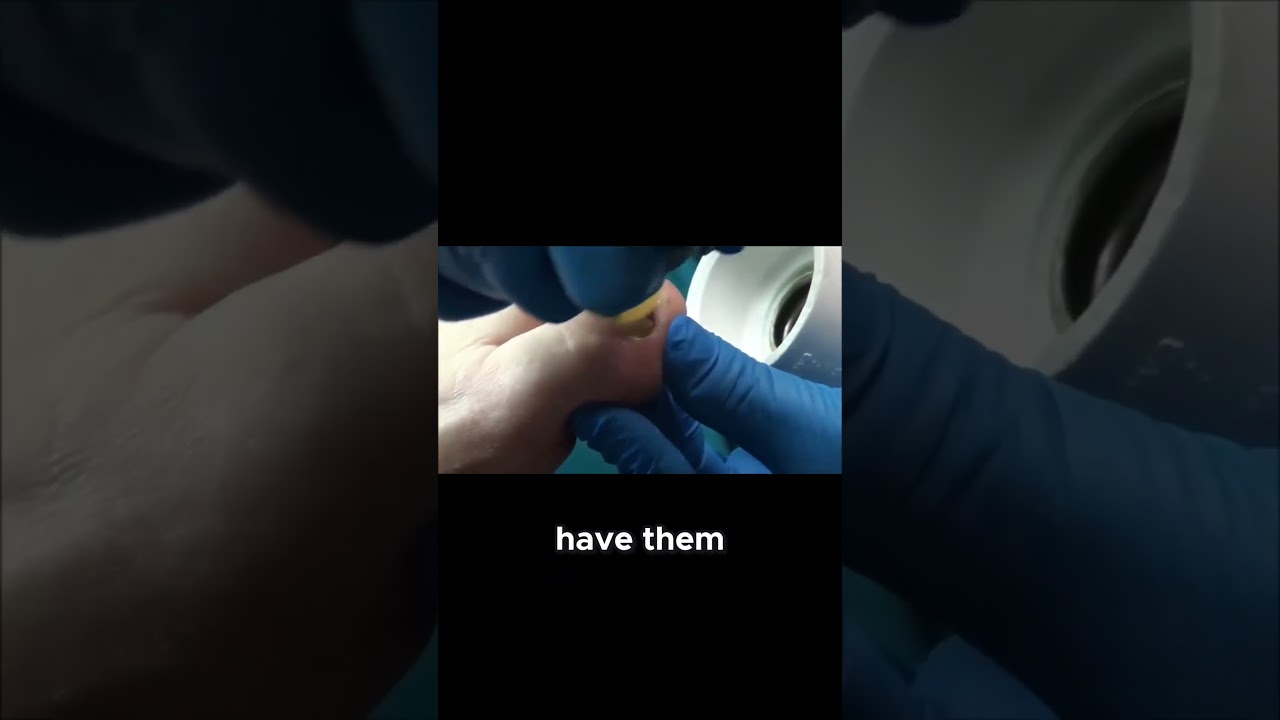 Don't Be Embarrassed Seek Professional Help #NailCareAdvice #OvercomingEmbarrassment #foothealth 1