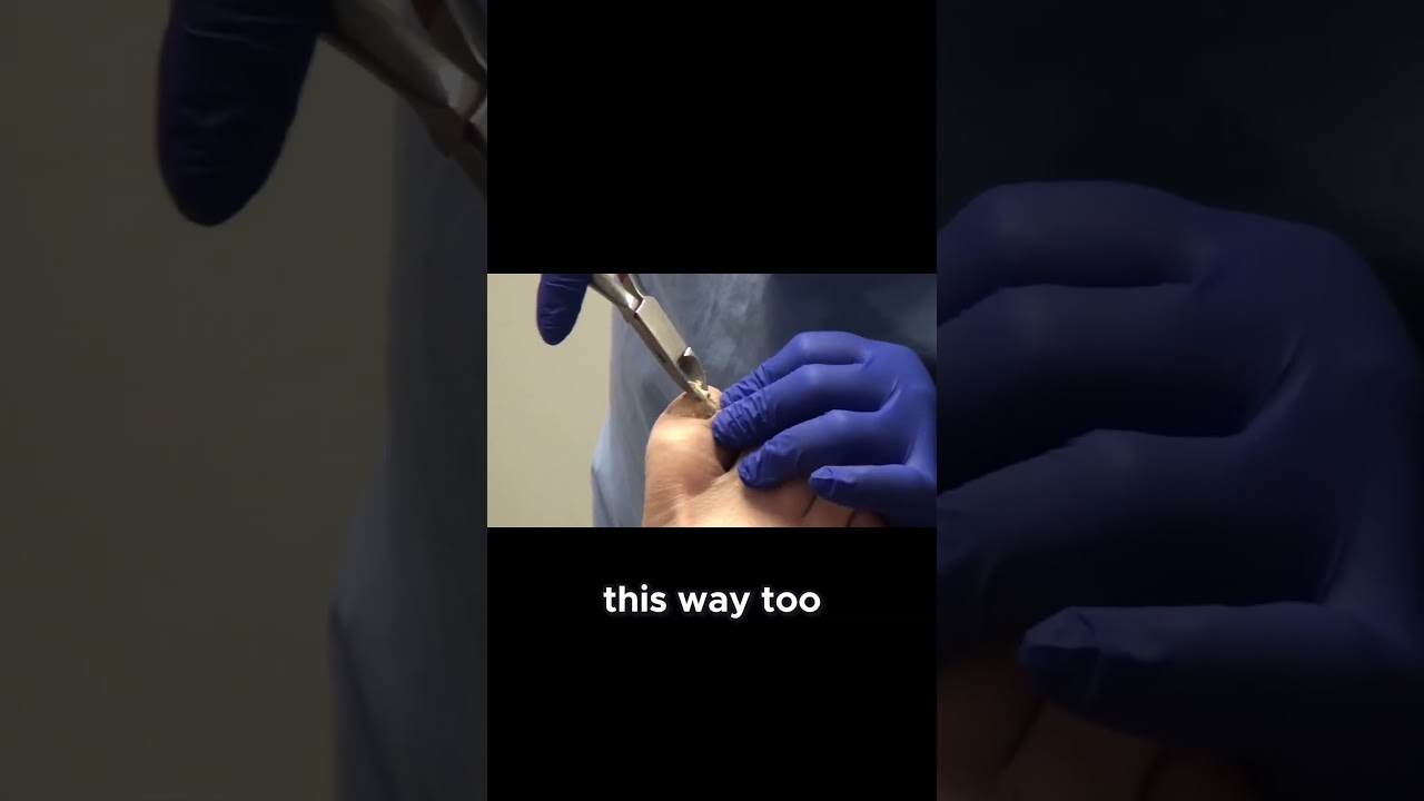 Discover the technique of thinning out a thickened nail for better comfort! #NailCare #Podiatry 1