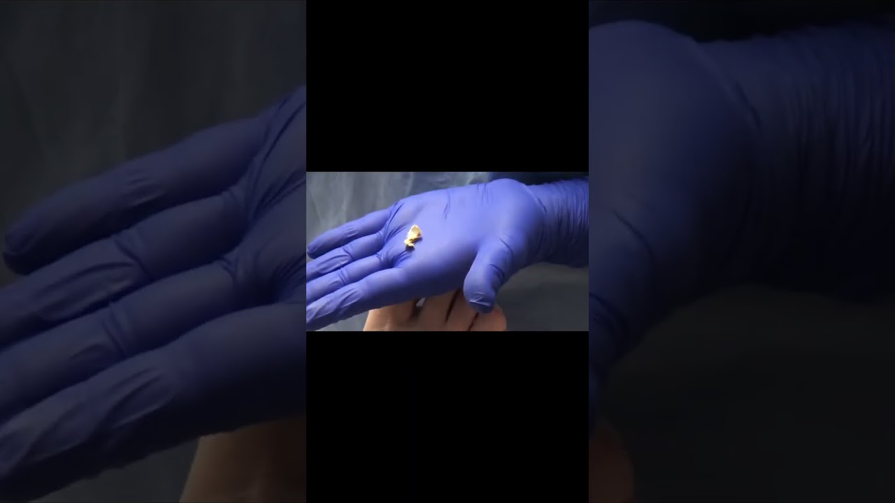 Witness the fascinating process of transforming a ram's horn nail! #PodiatryMagic #HealthTips 4