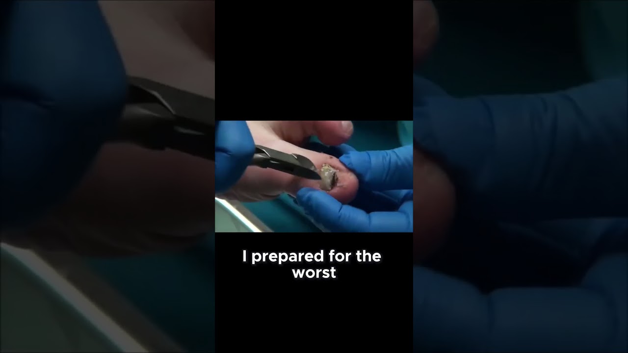 Erica's Toenail Transformation From Pain to Relief; toenail injury. #FootCareJourney #InjuryRecovery 4