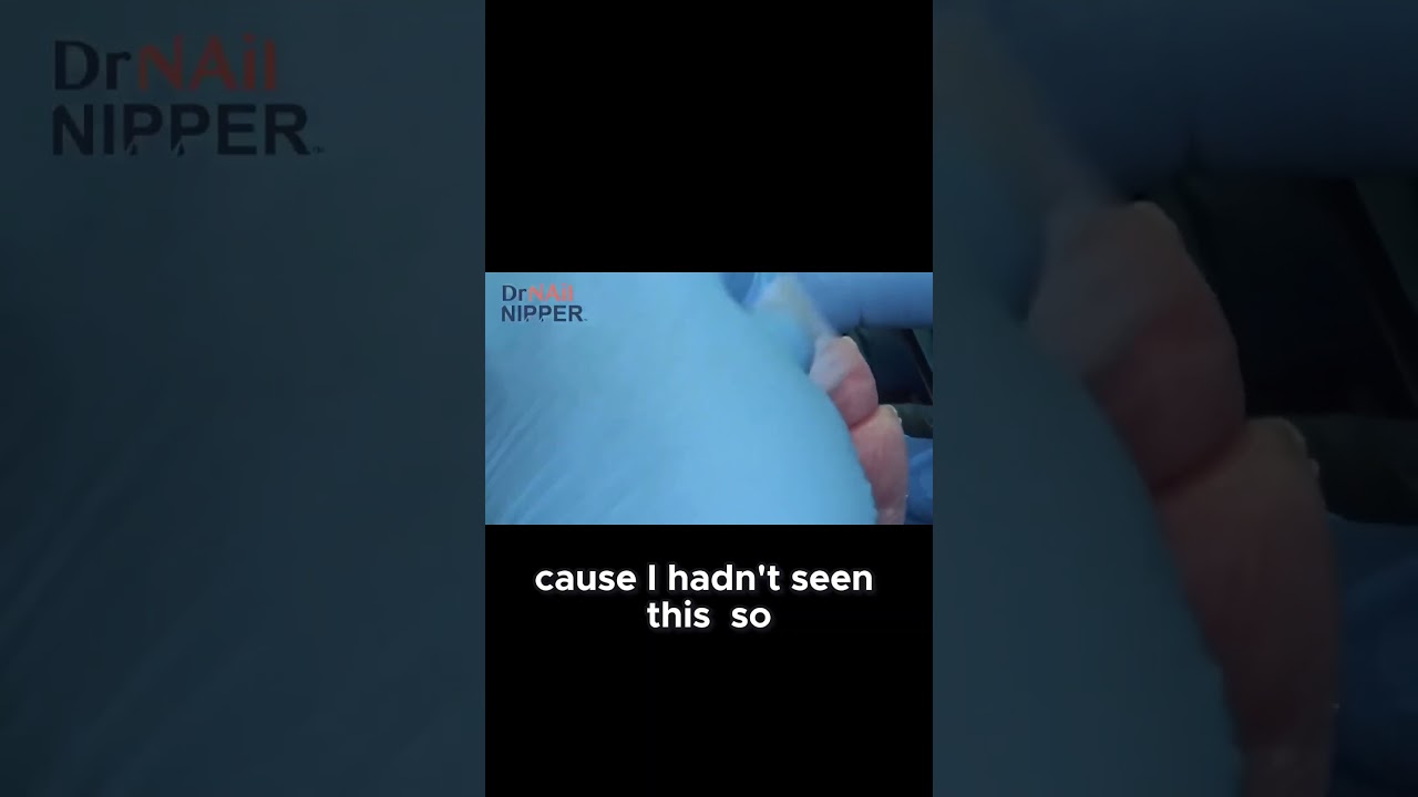 Join the treasure hunt under the callus! #TreasureHunt #CallusExploration #medicaljourney 4