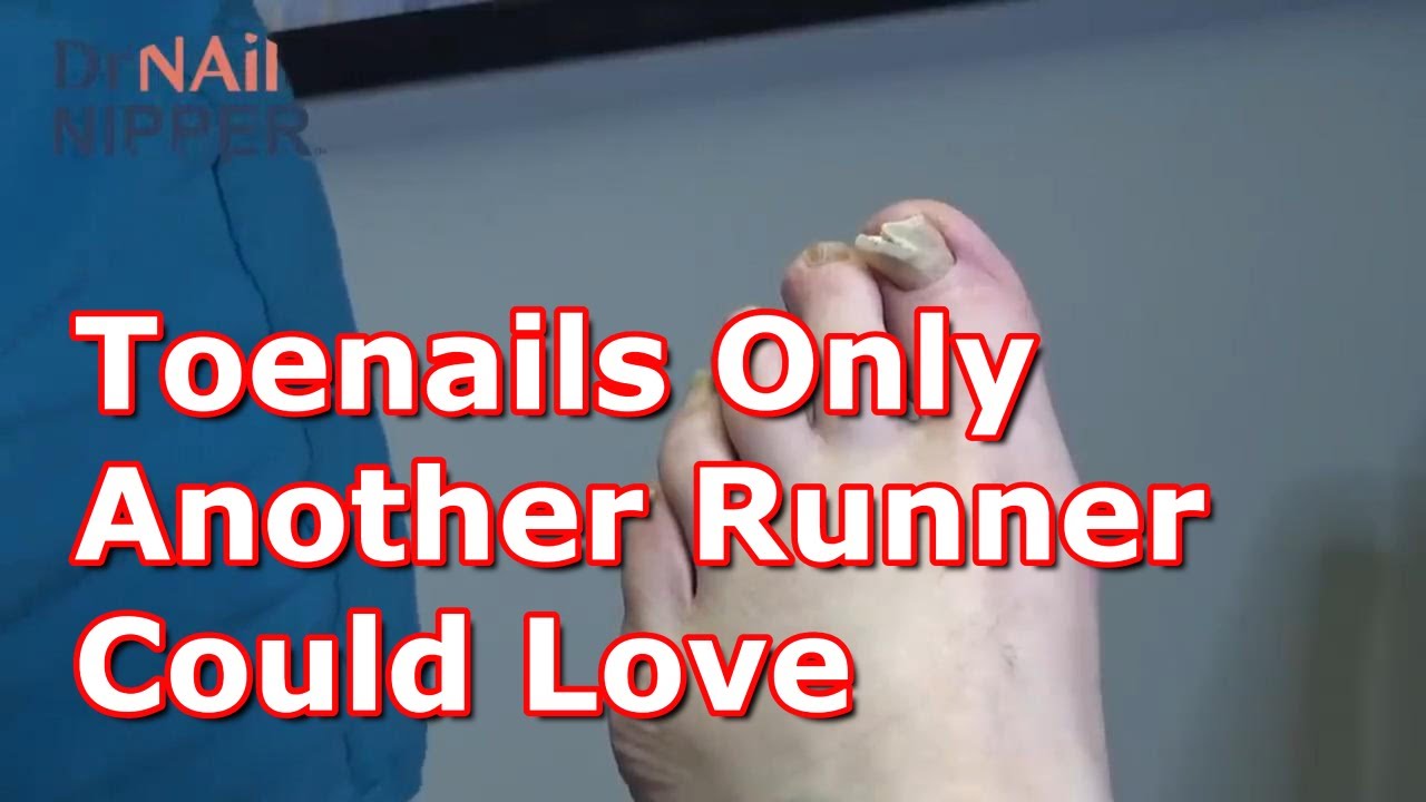 Toenails Only Another Runner Could Love from 2020 👩🏻‍⚕️🦶👣🦵🚶🏃 1