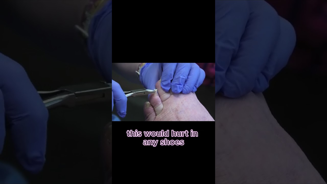 Long Toenails and Shoe Struggles #toenails #shoeinserts #shoes 1