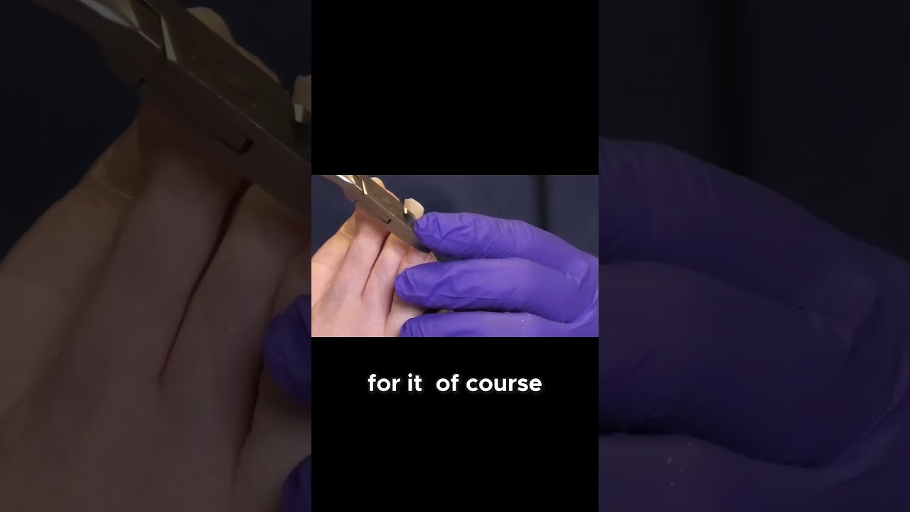 Nail Care Tips for EDS Patients 1