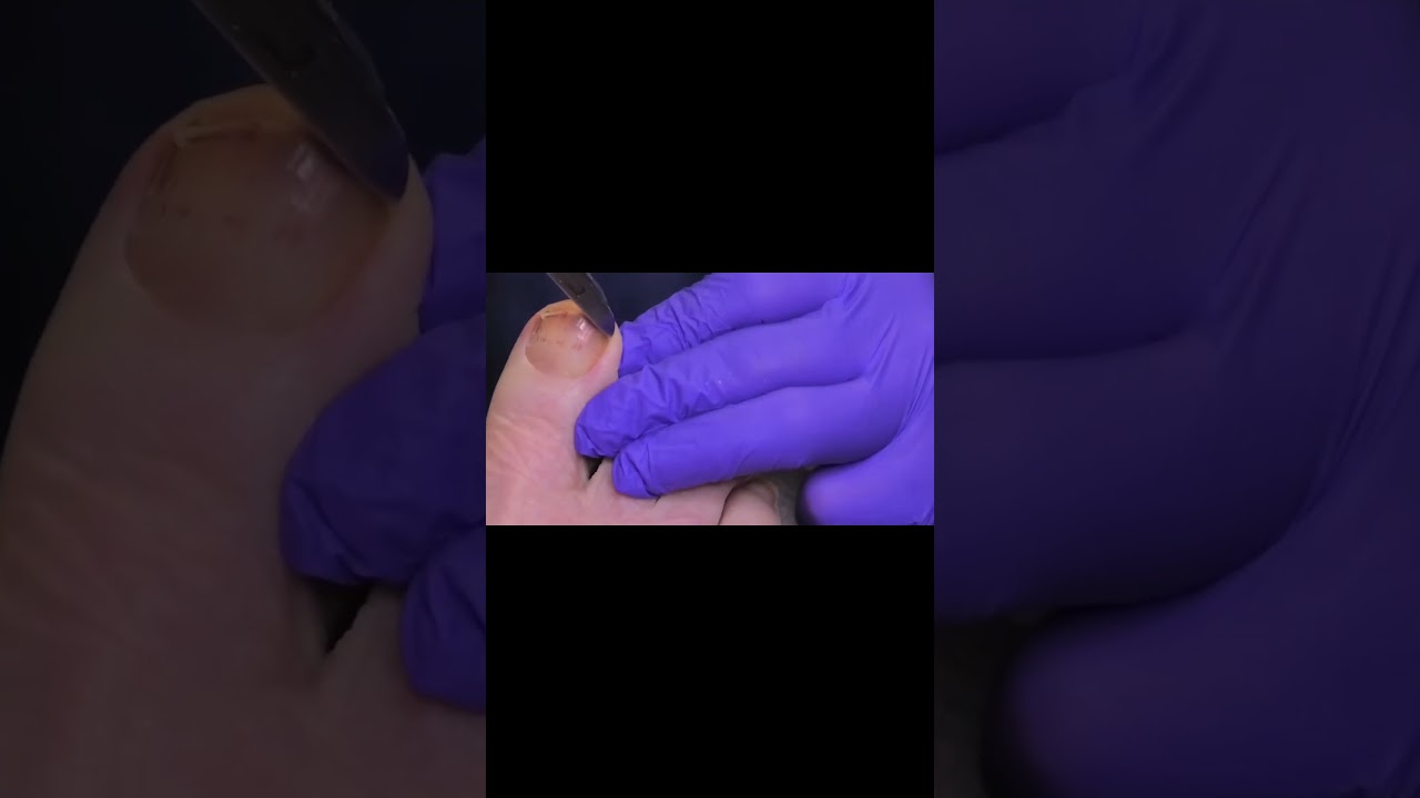 Facing Cancer Head-On: A Brave Journey #CancerAwareness #EarlyDetection #bravejourney 1