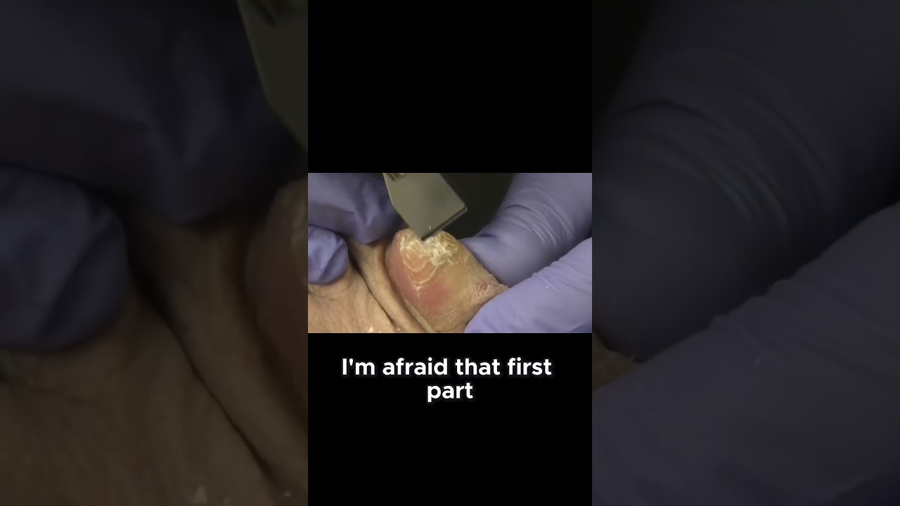 Understanding Nail Health Causes of Yellow Toenails #NailCare #HealthTips #YellowNails 1