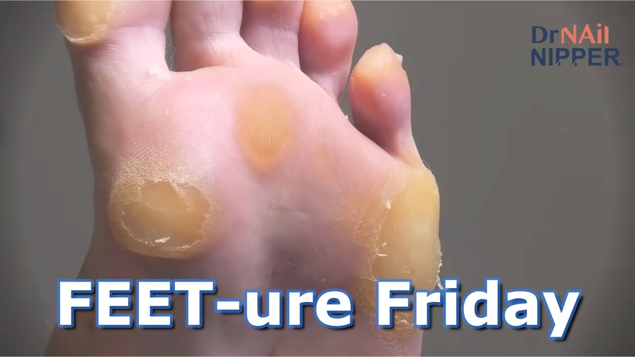 FEETure Friday | Why are these calluses SOOOOO Thick #callustoday #callusnow 1