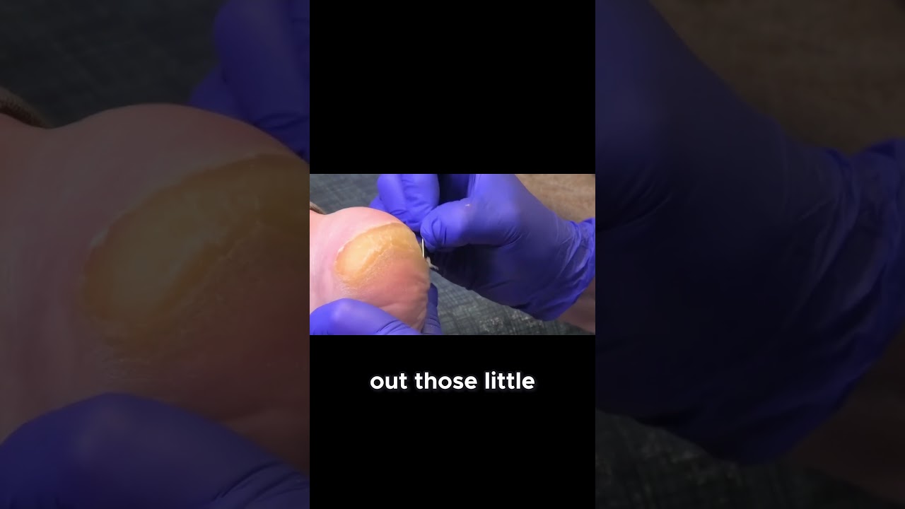 Managing Thick Calluses No Cure! #CallusManagement #healthtips #skincare 1