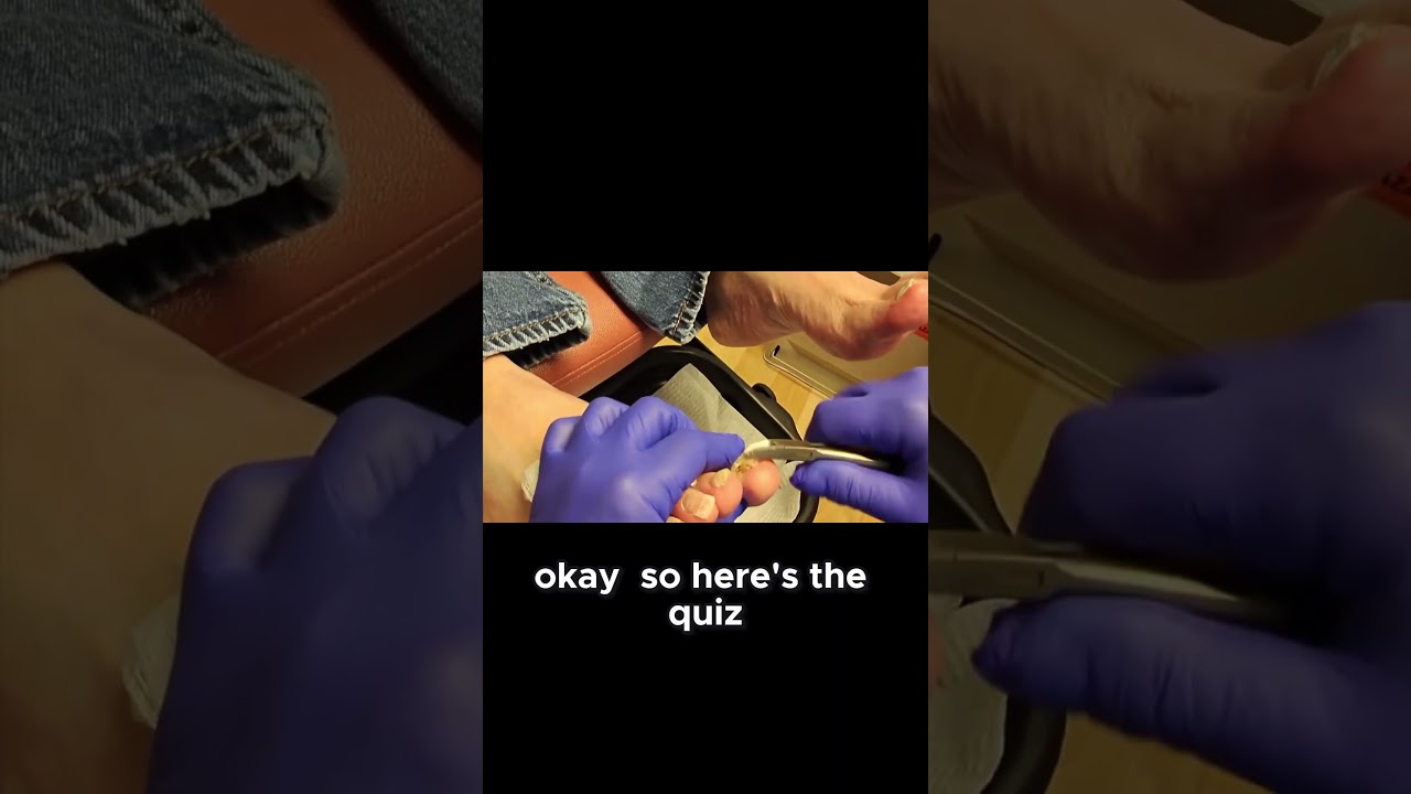 Daily Foot Checks A Diabetic's Routine! #diabetic #footcare 1