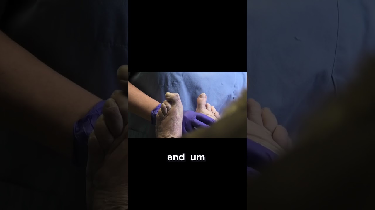 Understanding Rheumatoid Arthritis in Feet. #rheumatoidarthritis #foothealth #medicalinsights 1