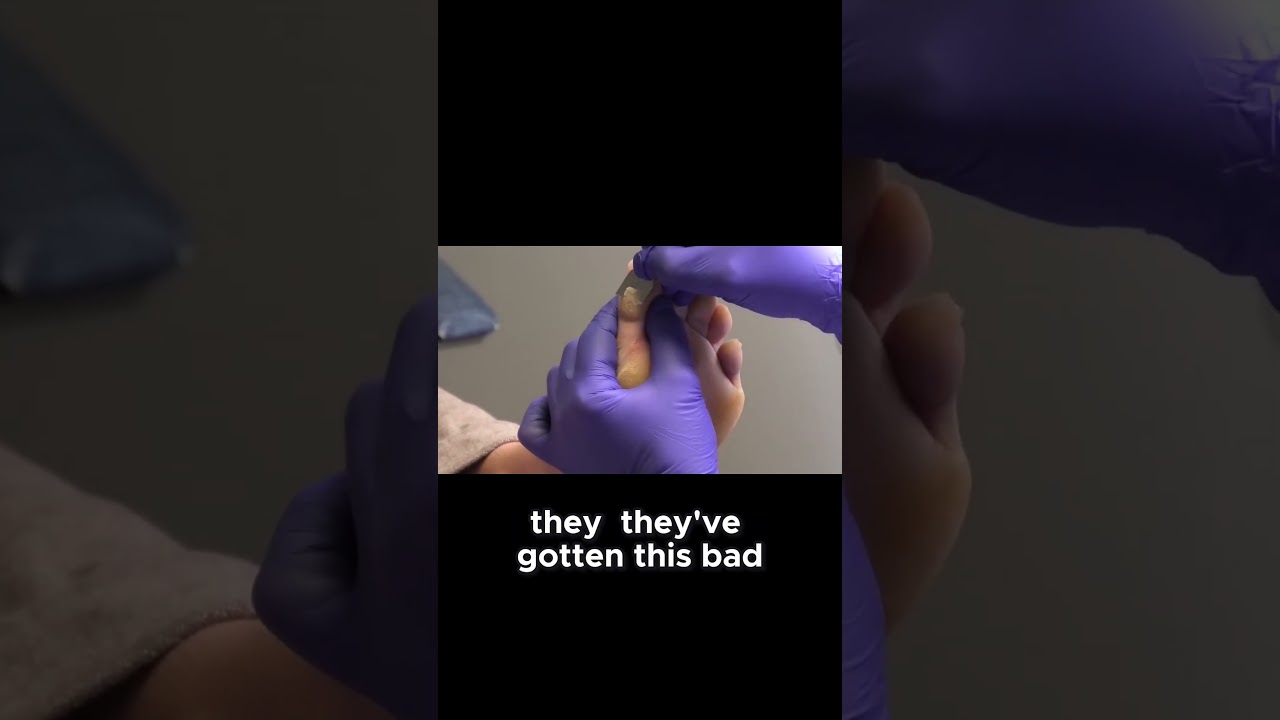 Genetic Condition Causes Thick Calluses #GeneticCondition #calluses #healthtalks 1