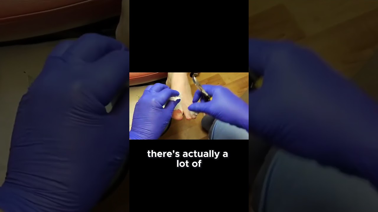 Watch This Pus-Filled Ingrown Nail Extraction #footcare #IngrownNail #PusExtraction 1