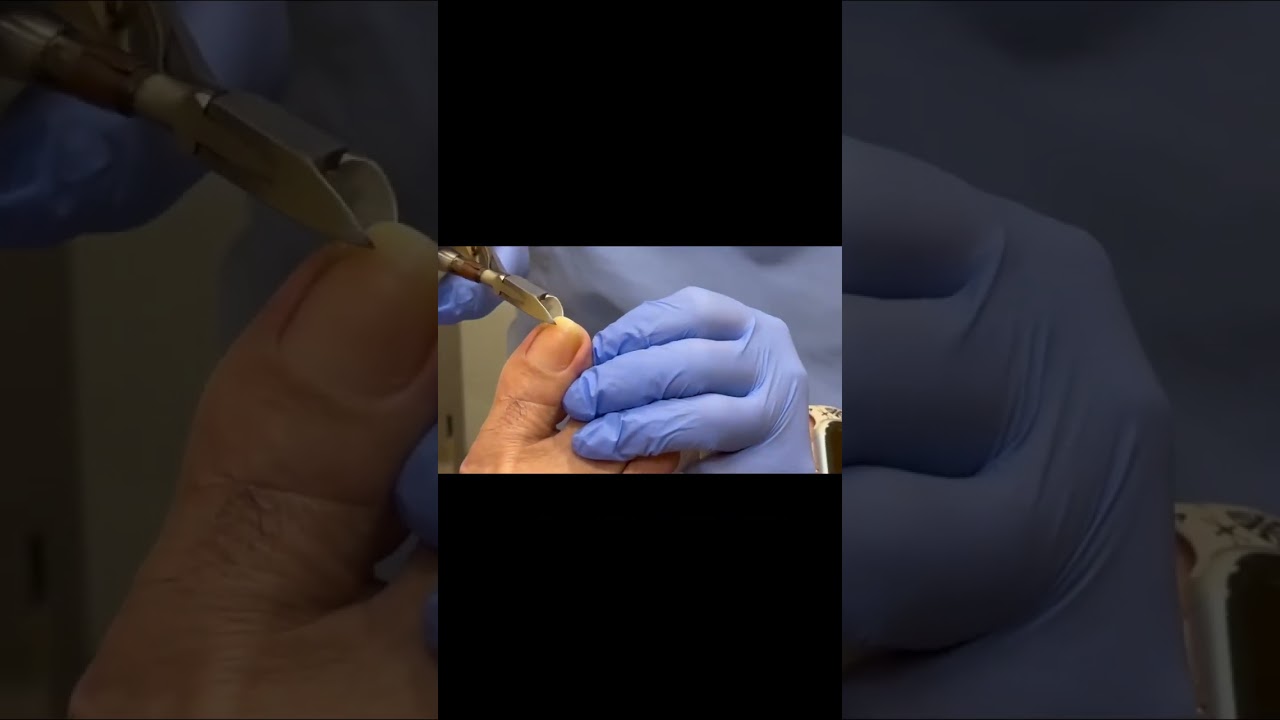 ¡Nunca camines descalzo si tienes diabetes! #Diabetes #CuidadoDePies #Salud #Prevención 1