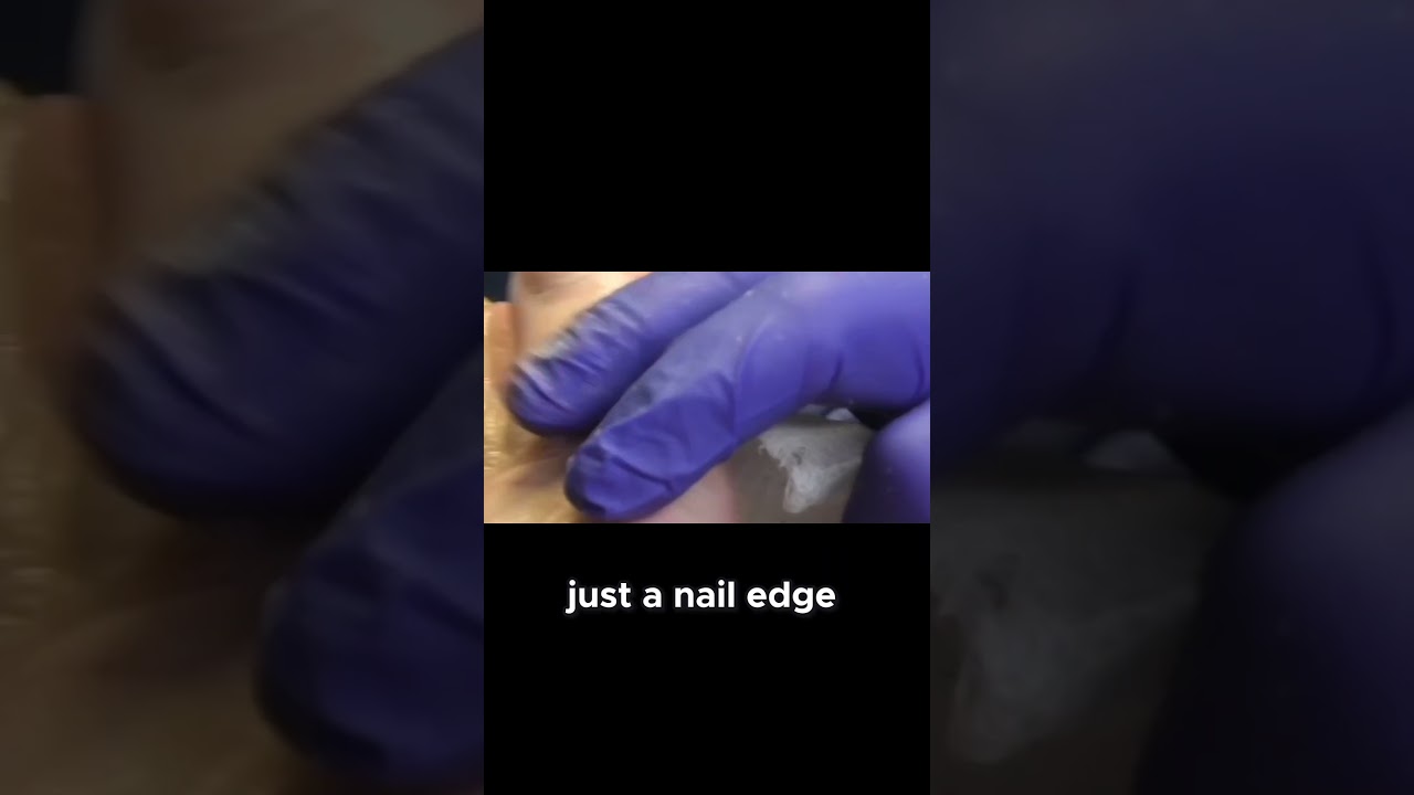 Curious about nail removal recovery? #NailCare #RecoveryJourney #HealthTips 1