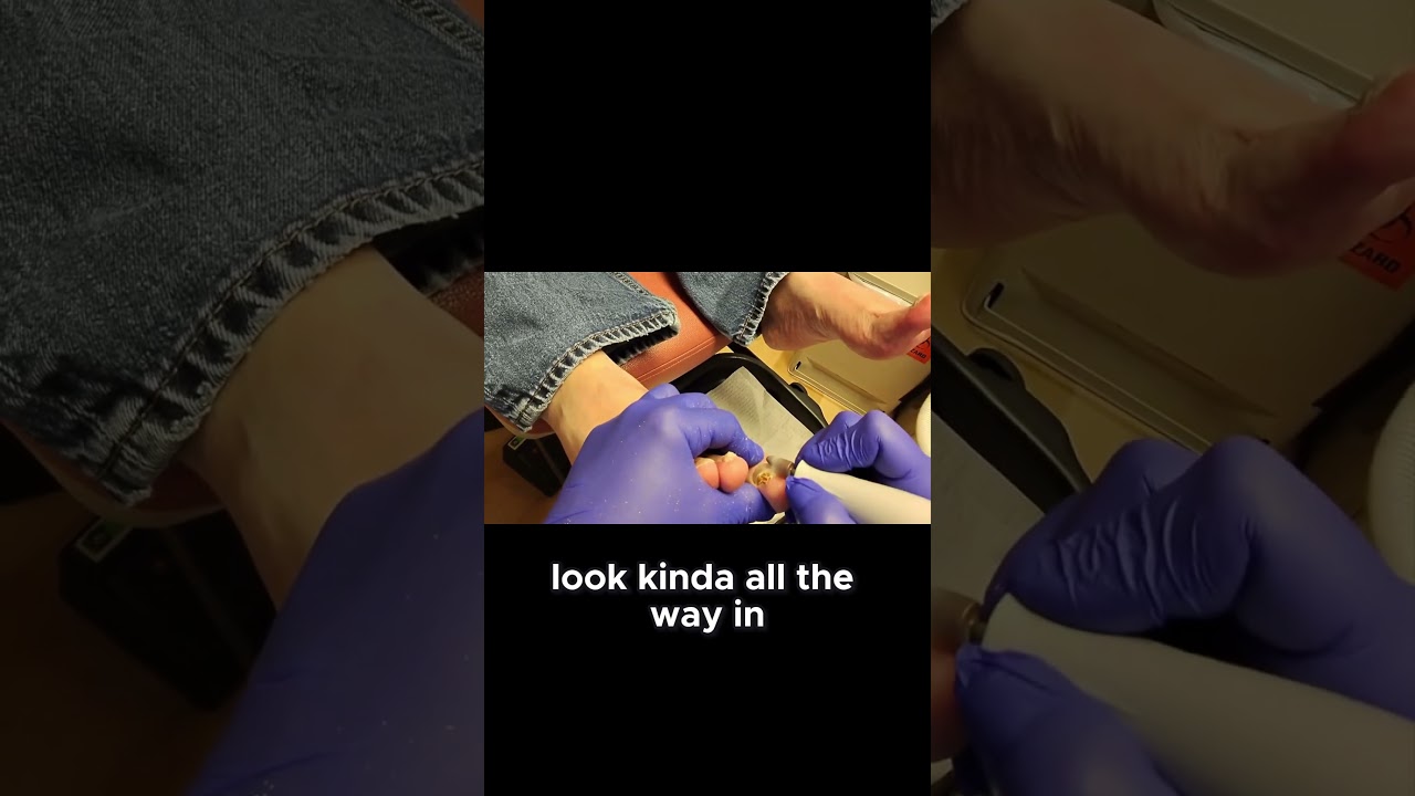 Dealing with Toenail Fungus Tips and Tricks #ToenailCare #FungusTreatment #DiabeticTips 1