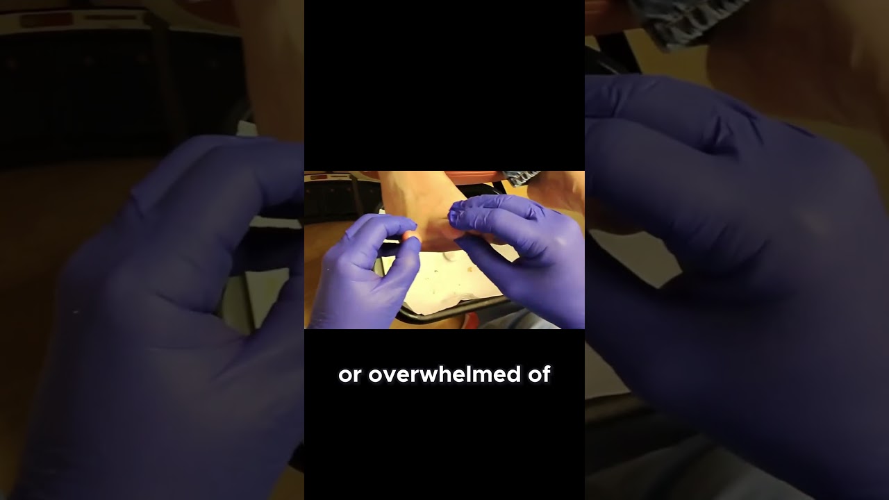 Professional Toenail Trimming for Diabetics #ToenailTrimming #diabeticcare #professionalhelp 1