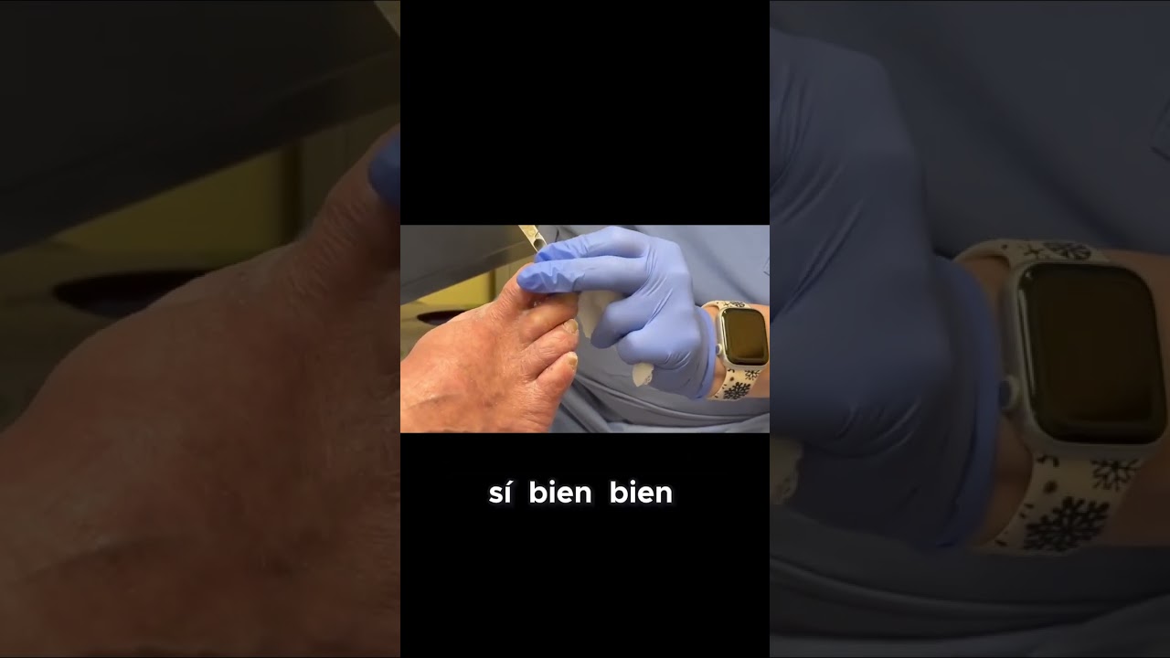 ¿Cómo cortar callos y uñas en pies diabéticos? #Diabetes #CuidadoDePies #Salud #Prevención 1