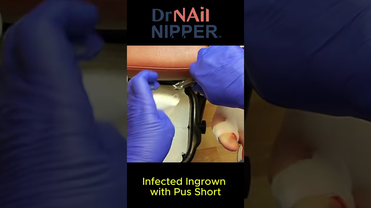 Infected Ingrown with Pus - Short #ingrowntoenailtreatment #ingrowntonail 1