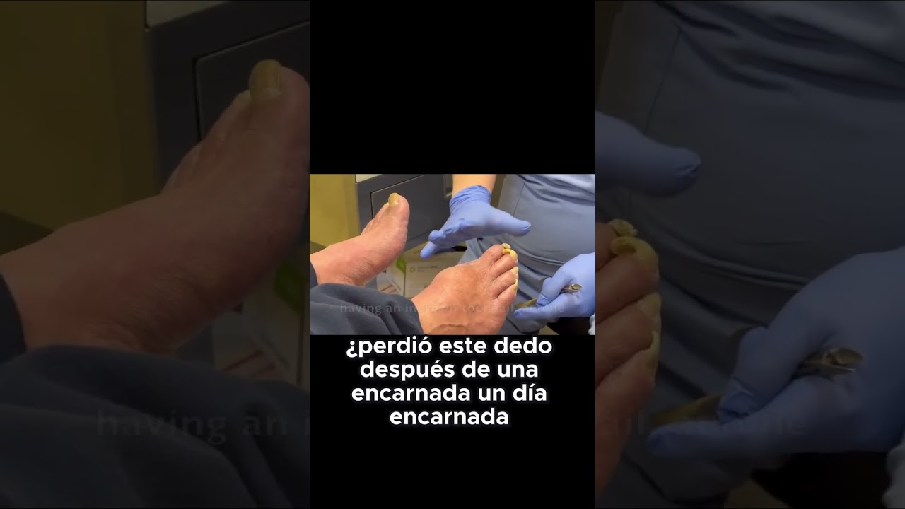 ¡30 años con diabetes y una amputación! #Diabetes #Salud #HistoriasReales #Prevención 1