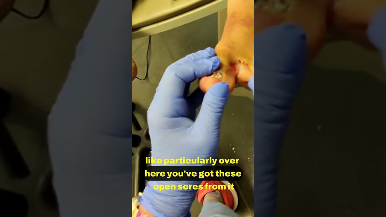 Understanding Athlete's Foot and Its Impact 🏃‍♂️🦵 1