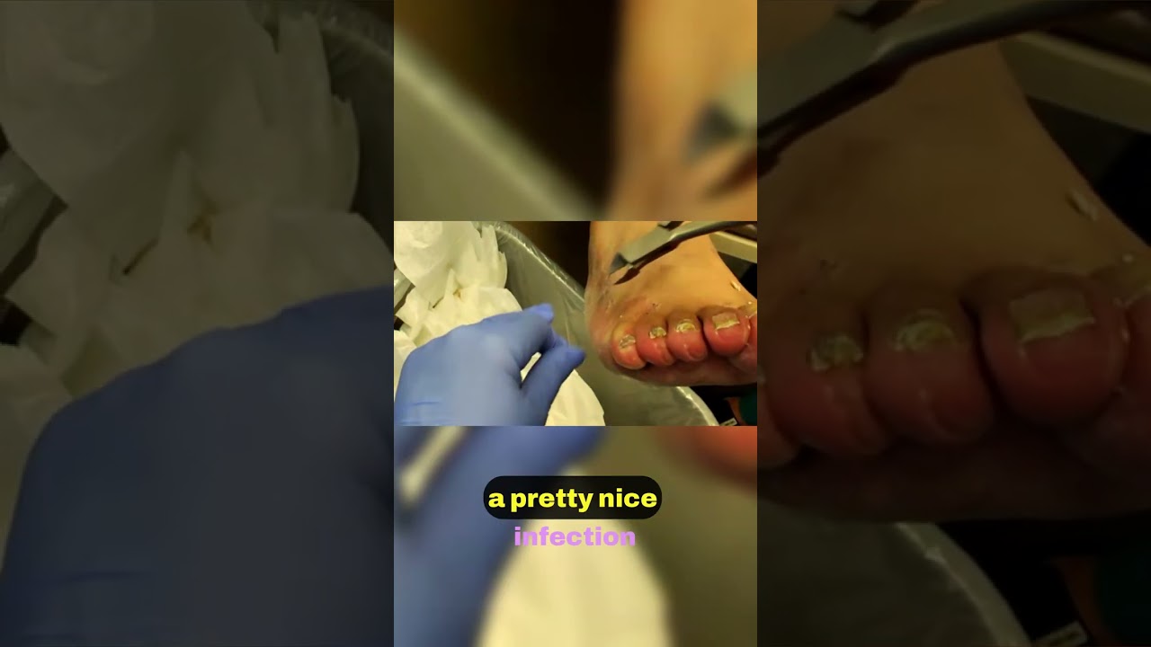 Unique Nail Treatment Insights 🦶💡 1