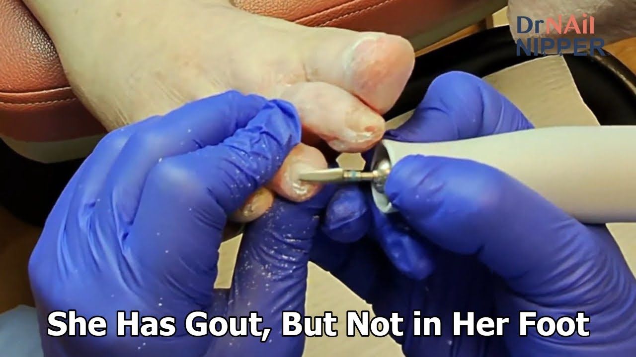 She Has Gout, But Not in Her Foot 1