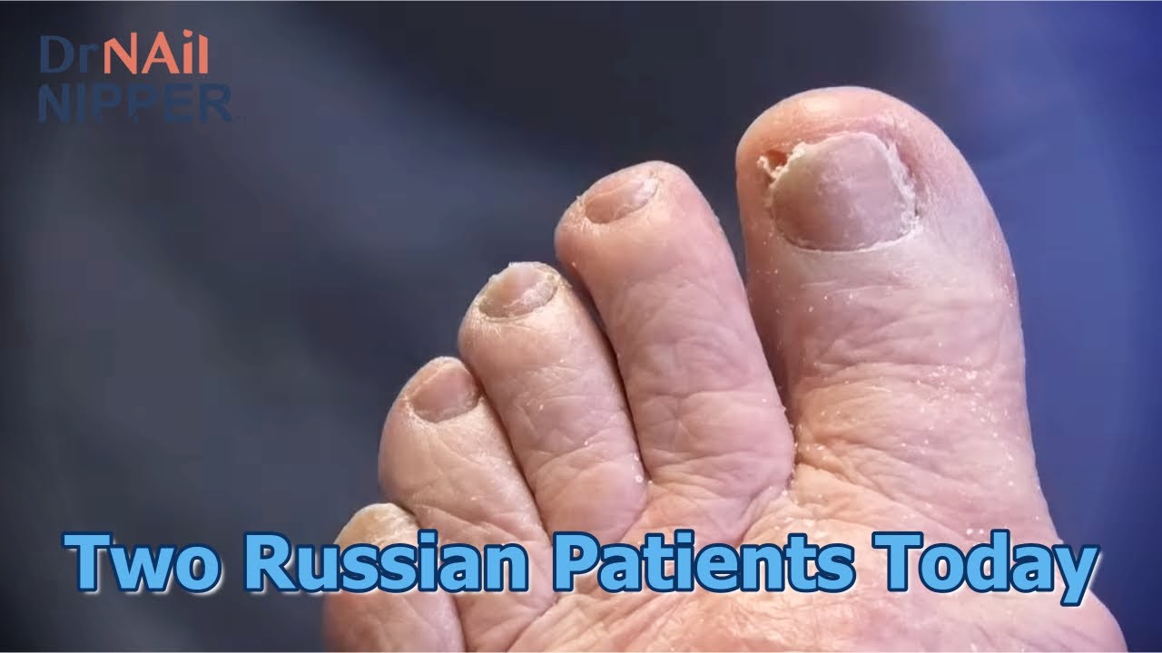 Two Russian Patients Today #foothealth #russian 6